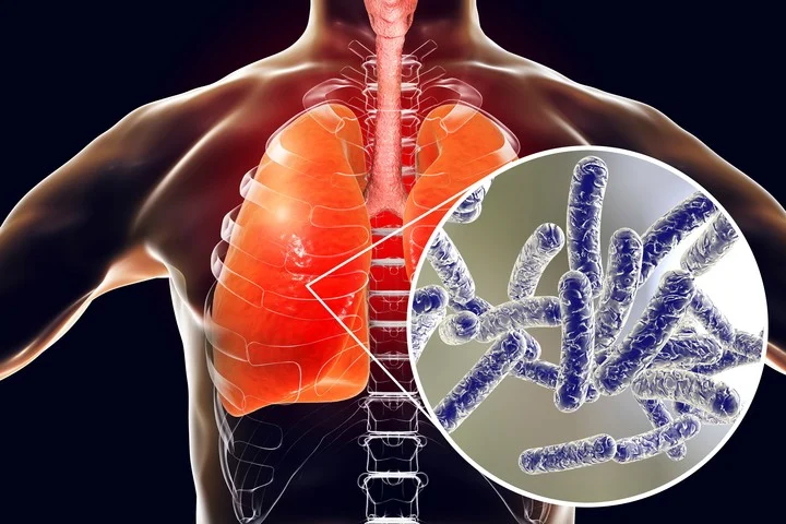 Brote de Legionella en Tucumán: ya son 6 los muertos por la bacteria y se sumaron 8 nuevos casos