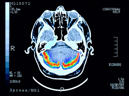 Resiliencia cognitiva, el concepto que puede modificar el pronóstico del Alzheimer para siempre y que tiene detrás a un científico argentino