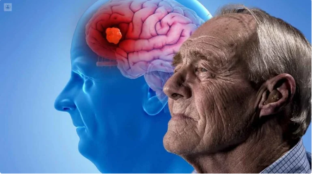 Tres interrogantes de los expertos sobre el medicamento que retrasa el avance del Alzheimer aprobado por FDA