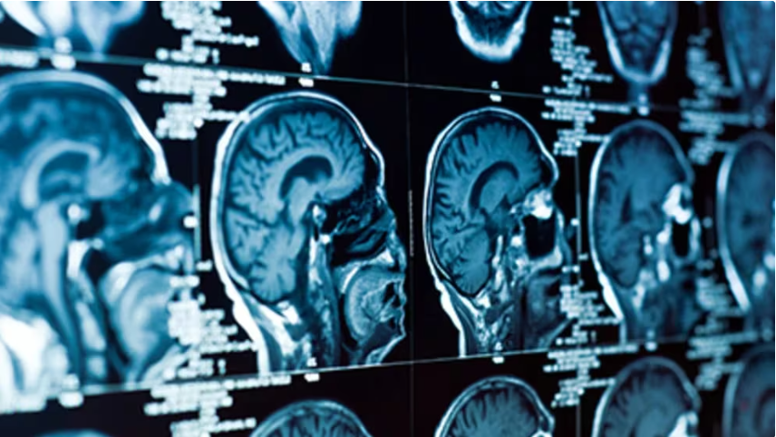 Científicos de Harvard estudian cuál es la zona del cerebro que revela el inicio del deterioro cognitivo